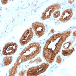 IHC of human breast carcinoma stained with HER4 Mouse Monoclonal Antibody AE00226