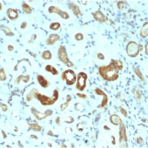 IHC of human renal carcinoma stained with STAT3 Mouse Monoclonal Antibody AE00232