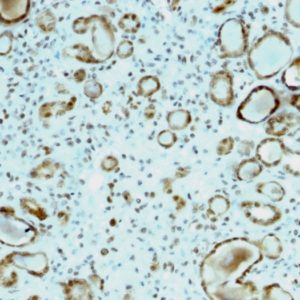 IHC of human renal carcinoma stained with STAT6 Mouse Monoclonal Antibody AE00235