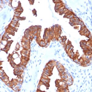 IHC of human endometrial carcinoma stained with KRT7 Mouse Recombinant Monoclonal Antibody AE00252