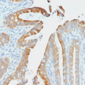 IHC of human colon carcinoma stained with KRT19 Mouse Recombinant Monoclonal Antibody AE00253