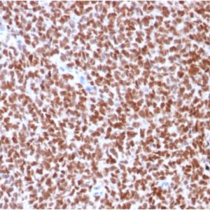 IHC of human Ewing's sarcoma stained with NKX2-2 Mouse Recombinant Monoclonal Antibody AE00256