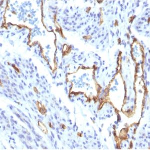 IHC of human Angiosarcoma stained with CD31 Rabbit Recombinant Monoclonal Antibody AE00257