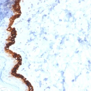 IHC of human basal cell carcinoma stained with KRT15 Mouse Monoclonal Antibody AE00281