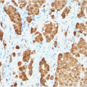 IHC of human melanoma stained with S100B Rabbit Recombinant Monoclonal Antibody AE00287