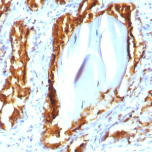 IHC of human prostate carcinoma stained with ACPP Mouse Recombinant Monoclonal Antibody AE00101